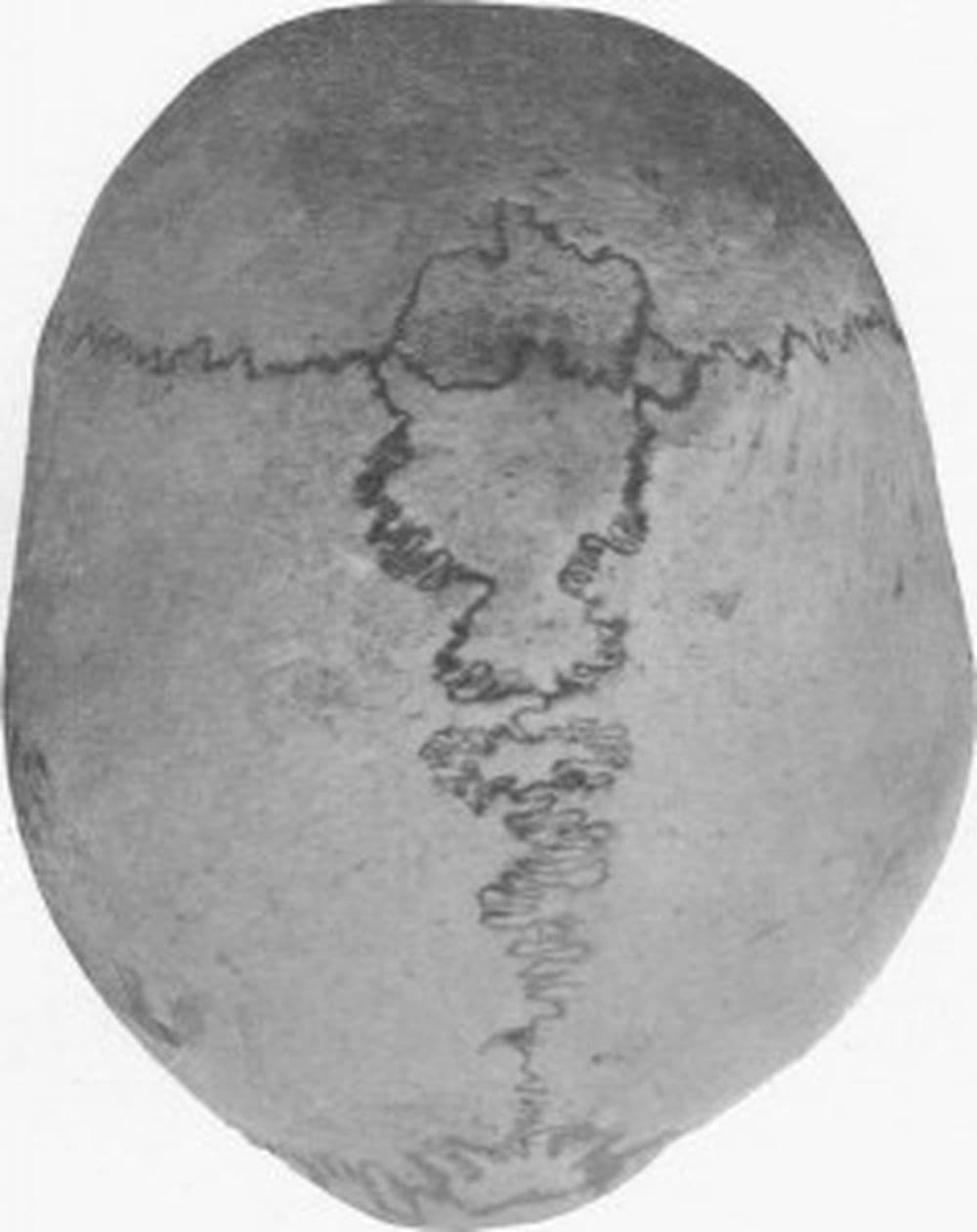 Das Inkabein. Photo Credit: E. Barclay-Smith: A Rare Condition of Wormian Ossifications. J Anat Physiol , 277–278 (1909)